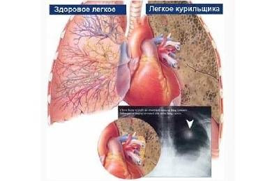 астма и курение